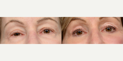 65-74 year old woman treated with Eyelid Surgery, Double Eyelid Surgery, CO2 Laser - This 70-year-old patient came to Dr. Wise for an upper and lower blepharoplasty. He also performed CO2 laser skin resurfacing. The combination of procedures left this patient feeling more alert, awake, and refreshed. She no longer has to struggle with looking tired or with her heavy eyelids weighing her down.
