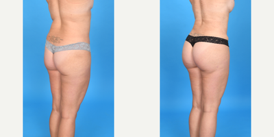 35-44 year old woman treated with Body Lift, Brazilian Butt Lift, Brazilian Butt Lift Revision, Butt Augmentation, Butt Lift, La - Before and after skinny BBL as part of a mommy makeover: Breast augmentation, tummy tuck, and BBL. We added 500cc pure fat to each butt to give a better shape and size. I call this a skinny BBL as the goal is always a perfect shape and not necessarily maximum volume.