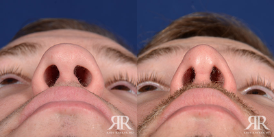 Rhinoplasty - Rhinoplasty