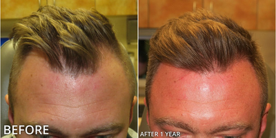 Man treated with Hair Transplant, ARTAS Robotic Hair Transplant - Man treated with Hair Transplant, ARTAS Robotic Hair Transplant