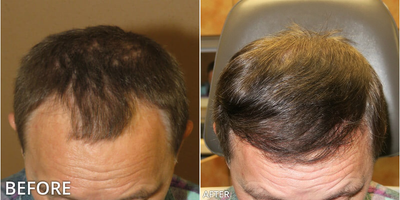 Man treated with Hair Transplant, ARTAS Robotic Hair Transplant - Man treated with Hair Transplant, ARTAS Robotic Hair Transplant