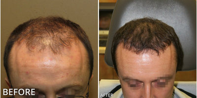 Man treated with Hair Transplant, ARTAS Robotic Hair Transplant - Man treated with Hair Transplant, ARTAS Robotic Hair Transplant