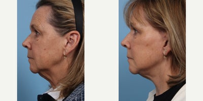 65-74 year old woman treated with Deep Plane Facelift, Eyelid Surgery - Deep Plane Facelift and Upper Eyelid Blepharoplasty
