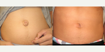 18-24 year old man treated with Belly Button Surgery - This is a 20-year-old young man who had repair of a large umbilical hernia at age 5. The hernia repair was successful, however, he was left with unsightly redundant, scarred and stretched skin. He is seen here 3 months after umbilicoplasty.