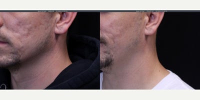 Man treated with UltraClear Laser - Man treated with UltraClear Laser