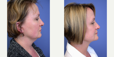 55-64 year old woman treated with Smart Lipo - 56 year old female who underwent Smartlipo of her neck