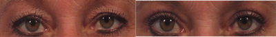 Upper eyelid lift (blepharoplasty) with CO2 laser skin resurfacing - Upper eyelid lift was performed with upper eyelid skin laser resurfacing for loose upper eyelid skin and wrinkles from sun damage