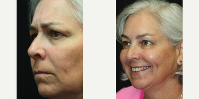 50 year old woman treated with Botox for Migraines - 50 year old woman seeking to address early signs of aging consulted with Dr. Kris Reddy FACS. Dr. Reddy performed Botox about 40 units and dermal fillers (1 syringe of Juvederm Ultra in the nasolabial folds and perioral lines and 1 syringe of Voluma for the lower face and chin area). Patient wanted to have Botox performed for cosmetic reasons and to treat migraine headaches.
