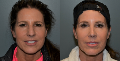 45-54 year old woman treated with Rhinoplasty - This 50 year old woman is 5'2 tall and weighs 115 pounds. She felt the shape of her nose did not fit the rest of her face and disliked the bags and lines of her lower eyelids. She had a rhinoplasty and lower lid blepharoplasty, (lower eyelid lift), completed at the same time. The results are shown at 9 months after surgery.