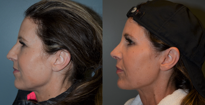 45-54 year old woman treated with Rhinoplasty - This 50 year old woman is 5'2 tall and weighs 115 pounds. She felt the shape of her nose did not fit the rest of her face and disliked the bags and lines of her lower eyelids. She had a rhinoplasty and lower lid blepharoplasty, (lower eyelid lift), completed at the same time. The results are shown at 9 months after surgery.
