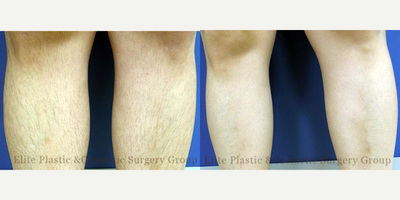 35-44 year old woman treated with Laser Hair Removal on Lower Legs - Pre- & 2 Months Post-treatment - Patient treated with Laser Hair Removal on Lower Legs - Before & 2 Months After 5th Session