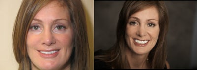 Porcelain Crowns & Bridge; Porcelain Veneers; Composite Restorations - 
	Patient presented with missing teeth; narrow smile and old restorations. Widened smile with porcelain veneers and bridge as well as restored healthy mouth with porcelain crowns and restorations.
