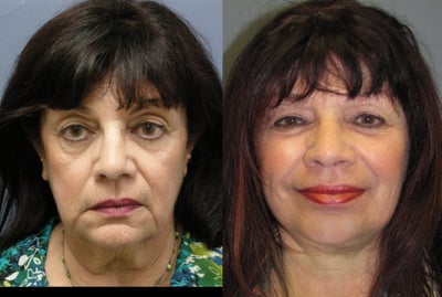 Lite Lift (TM) - 
	The Lite-lift is a modified facelift, that reduces signs of aging of the lower face, jawline, and neck. Patients looking for affordable and quick facial rejuvenation should take a serious look at our Lite-lift. The Lite-lift can be performed in office under local anasthesia, uses long lasting techniques, and because the incisions are limited, there is less bruising, swelling and healing time for most patients. Patients can be back to work in one to two weeks looking rested and more youthful.
