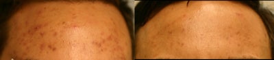 Cutera Laser Genesis - 
	Male patient treated with Laser Genesis for acne scarring. Post picture after 5 treatments.
