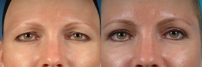 upper lid blepharoplasty (eyelid lift) - 
	upper lid blepahroplasty can reduce excess skin in the upper eyelids and provide a refreshed look and feel with relatively minimal recovery time
