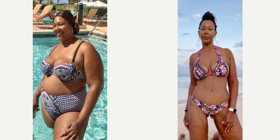 35-44 year old woman treated with Sleeve Gastrectomy - Sleeve Gastrectomy Patient