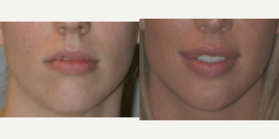 25-34 year old woman treated with Lip Surgery - This young woman underwent hyperaesthetic surgery including Dr Haworth's signature FATMA technique on the upper lip so as to balance it with the full and pouty lower. With tactical mucosal tissue rearrangements performed on the inside of the upper lip alonf with fat transfer, a beautiful, harmonious, all natural&nbsp;and permanent&nbsp;result is obtained.