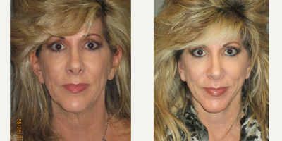 45-54 year old woman treated with Fractional Laser - This woman presented with a history of moderate to severe acne as a young adult.  She had significant texture irregularities as a direct result of scarring from her acne.  After proper education and consultation we decided together to perform a full face fractional CO2 laser treatment.  This was performed in our Center under local anesthesia and oral sedation. Her recovery time was approximately one week and had noticeable improvements in the overall texture, tone, and feel of her skin.  Due to the severity of her condition, we did discuss a possible second treatment with the laser in the future.