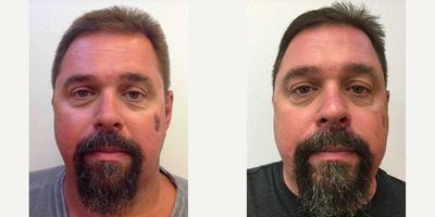 45-54 year old man treated with IPL - A 47-year-old Male treated with two sessions of IPL Laser to reduce the appearance and discoloration of a Port Wine Stain.