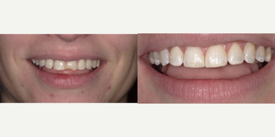 35-44 year old woman treated with Tooth Repair, Dental Bonding - Patient broke her left central incisor. Dr. D used cosmetic bonding with micro-ceramic composite to repair the tooth fracture and restore her smile.