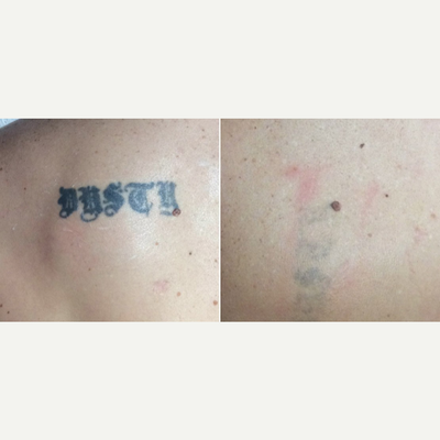 45-54 year old woman treated with Enlighten - After just 5 Enlighten laser tattoo removal treatments.