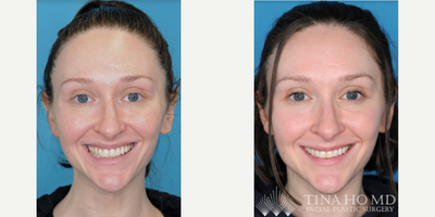 25-34 year old woman treated with Botox for Gummy Smile - 30 year-old female who received neurotoxin injection to the upper lip for treatment of gummy smile