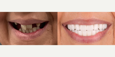 45-54 year old man treated with Dental Bonding - This patient received All-on-4 dental implants, restoring their smile with a full arch of secure, natural-looking teeth. The procedure provides lasting stability and function, allowing for an immediate transformation and renewed confidence.