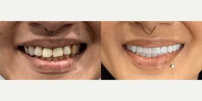 45-54 year old woman treated with Dental Bonding - This patient received All-on-4 dental implants, restoring their smile with a full arch of secure, natural-looking teeth. The procedure provides lasting stability and function, allowing for an immediate transformation and renewed confidence.