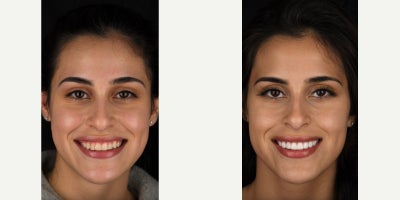 Minimal Drill Veneers - Shocking that we can achieve this stunning look without drilling teeth down like most other cosmetic dentists do. We are the only cosmetic dental clinic in Washington State doing Drill Free Veneers and Minimal Drill Veneers. These state-of-the-art Veneers dont require drilling down excessive amounts of the healthy enamel and teeth underneath.Dr. Keller has spent many years mastering the exceptionally difficult art of placing Veneers in this safe and non-invasive manner. We are miraculously doing cosmetic dentistry, but in an ethical manner! Most of the cosmetic dentistry performed in the world is considered by many to be somewhat unethical. This is due to the fact that it drills away excessive healthy enamel, all for the sole purpose of a cosmetic benefit. This is precisely the reason Dr. Keller has worked with an obsessive dedication for years....to finally master his craft of preserving teeth, and leaving them as healthy as possible underneath his Veneers. Perhaps the most challenging part of this non-invasive style, is to simultaneously achieve world-class beauty. Our patients smile is now stunning and natural, and the best part is that they didnt have to sacrifice their teeth to get there. World-class aesthetics, done in the safest manner possible.This is Dr. Kellers mission statement at our practice. This is our code of ethical practice, and we take it very seriously day in and day out.