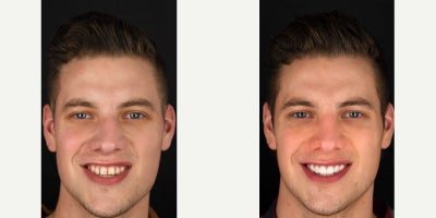 Upper 8 Porcelain Veneers - Life changing, the power of a perfect smile! How was this astounding smile makeover achieved? Dr. Keller used his exclusive Drill Free & Minimal Drill Veneers which were fused over the patients teeth. This rare technique left nearly all of their original enamel intact underneath. The Veneers established a youthful appearance to their face that speaks for itself in the after photo. This patient had dreamt for many years of a having radiant white smile. Therefore we chose a shade that would have just a little bit of a pop while still looking very natural. Its extremely rare for Veneers to have an appearance this natural while also having this level of whiteness. However Dr. Keller incorporates gorgeous and intricate details into our veneers that will leave everyone guessing. Unmatched realism, one of the many things we pursue relentlessly at Da Vinci Dental.