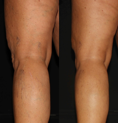 35-44 year old woman treated with Asclera - Results after one session of Asclera for spider veins on legs.