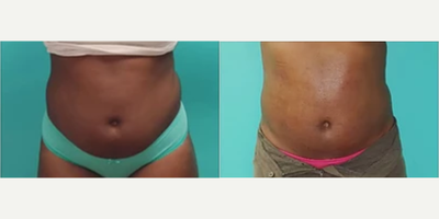 Woman treated with Lipodissolve - 6 sessions