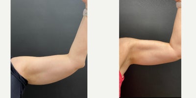 45-54 year old woman treated with Evolve - Evolve - treated by Alyssa G