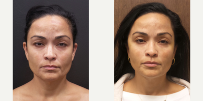 46-Year-Old Female After Silhouette InstaLift - This 46-Year-Old wanted to turn the clock back by a few years without going under the knife, and the doctorrecommended her Silhouette InstaLift - the thread lift procedure that is great for those patients who want to achieve immediate results with minimal downtime. During this treatment, absorbable sutures are placed under the skin where the lift is needed. Not only do these threads provide support for the face, but they also boost the production of collagen. Silhouette InstaLift is performed under local anesthesia.