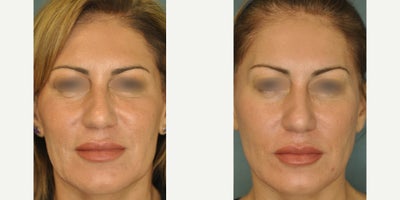 52 year old woman treated with Belotero Balance (+). - 52-year-old treated with 1 cc of Belotero Balance (+) to the under-eye hollows to smooth and appear alert and refreshed. Before and after images were taken 6 months post-treatment