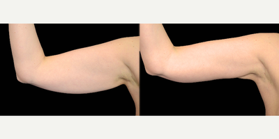 35-44 year old woman treated with Exilis - Photo courtesy of BTL - after 4 sessions