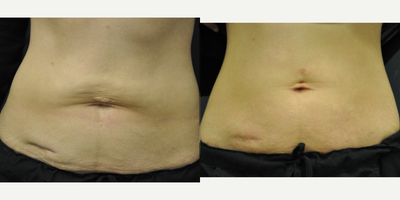 35-44 year old woman treated with Exilis - Photo courtesy of BTL - after 6 sessions