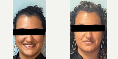 25-34 year old woman treated with Pixel Laser - This client has had problems with hyperpigmentation, acne scars and enlarged pores. After only two Clear Lift treatments she has had significant improvement. Typically 4-6 treatments are recommended however every client's treatment plan is based on there needs.