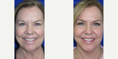 Woman treated with Facelift, Neck Lift, CO2 Laser - We performed our faceologylift combined with CO2 laser to lift her neckline, tighten her skin, and restore her jawline while improving the texture and tone of her overall complexion. These photos are one-month post-op and will continue to improve in the coming months.