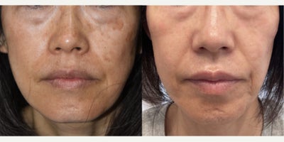 Q-switched laser treatment to remove age spots in Asian Skin, before and after - This Asian patient was interested in removing some very visible sun spots.  The challenge is that IPL treatments cannot remove these types of age spots, especially in Asian skin where the risk of side effects is higher.  But high powered more narrowly focused Palomar Q-yag V, q-switched laser easily did the job.  Before and after 2 laser treatments.