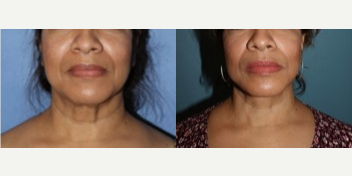 58 Year Old Face Lift Patient - This 58 year old came to us unhappy with her neck, jowls and jaw line.  After a face lift was performed, her neck and jaw line are more yourthful and she has a very natural result.