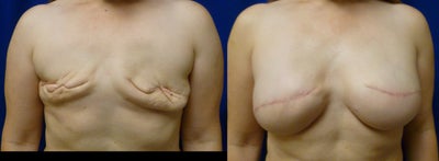 42 Year Old Delayed Breast Reconstruction with Expanders and Alloderm - 42 year old female, 5'1', 138 pound, underwent delayed breast reconstruction with expanders and Alloderm, and subsequent placement of 475 cc High Profile Silicine gel implants.