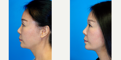 45-54 year old woman treated with FaceTite - FaceTite procedureFaceTite is a cutting-edge treatment designed to contour the face and neck without surgery. This new technology uses radiofrequency heat and energy to specifically melt fat and tighten skin. FaceTite is a scarless, minimally invasive procedure that can usually be done under mild sedation anesthesia, and it offers a rapid recovery.
