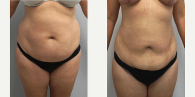 25-34 year old woman treated with Liposuction, SAFELipo, Power-Assisted Liposuction (PAL) - 25-34 year old woman seeking improved contour to her abdomen and flanks, treated with liposuction