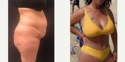 35-44 year old woman treated with Tummy Tuck, Liposuction, Mommy Makeover - 37 y.o female who underwent abdominoplasty which entailed removal of abdominal laxity, repair of diastasis recti, repositioning of umbilicus and liposuction of abdomen, flanks and back . At 3 months post-op, her contours are significantly improved.