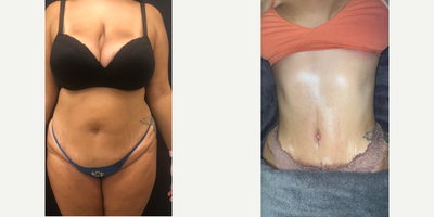 25-34 year old woman treated with Tummy Tuck, Liposuction, Mommy Makeover - 33 y.o female who underwent abdominoplasty which entailed removal of abdominal laxity, repair of diastasis recti, repositioning of umbilicus and liposuction of abdomen, flanks and back . At 1 month post-op, her contours are significantly improved. Her swelling will continue to improve with time.