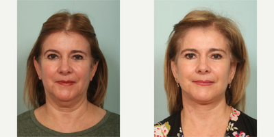 65-74 year old woman treated with Mini Facelift, Neck Lift - performed by Dr.Sozer