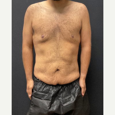 semaglutide results men before and after 3 months Results: Stories And Timelines Compounded Semaglutide: A Breakthrough in semaglutide weight loss before and