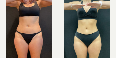 25-34 year old woman treated with Semaglutide - 30lbs lost on Tirzepatide
