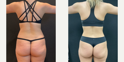 25-34 year old woman treated with Semaglutide - 30lbs lost on Tirzepatide